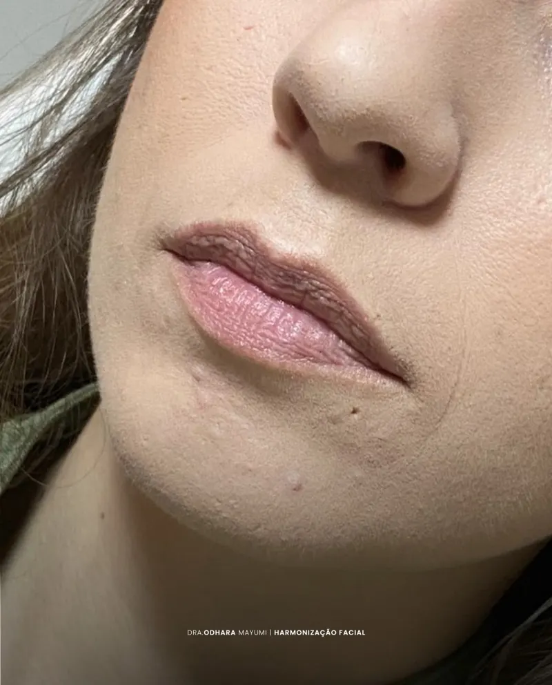 Preenchimento labial — Dra. Odhara Mayumi