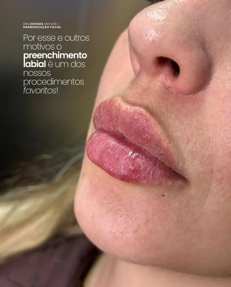 Preenchimento labial — Dra. Odhara Mayumi